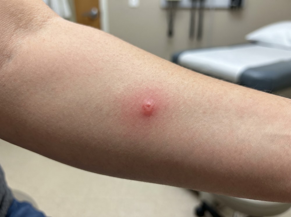 Close-up photograph of a fresh tarantula hawk wasp sting site showing a small red mark with minimal swelling and no blistering